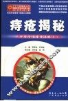 痔疮揭秘  告诉你如何面对肛肠疾病 封面