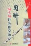 图解偏头痛针灸推拿治疗 封面
